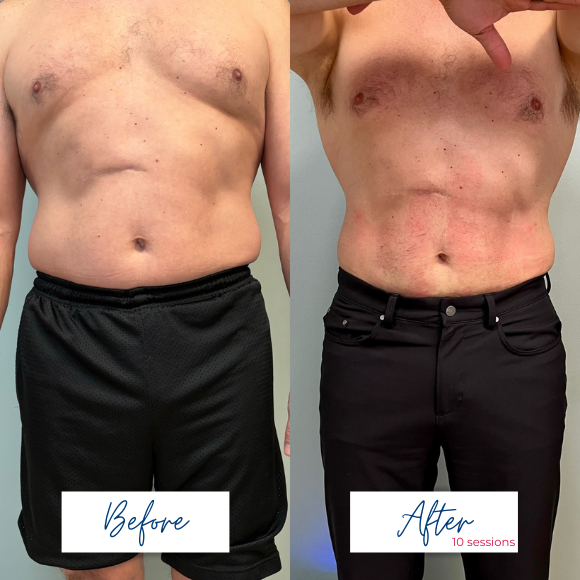 doctor hart before and after VIP BODi M